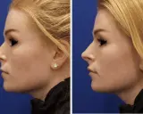 Profilo di donna prima e dopo rinofiller naso frontale. Il trattamento ha migliorato la linea del naso e del mento.