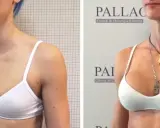Prima e dopo: seno rifatto taglia 2, un risultato naturale e armonioso.