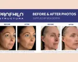 Profhilo Body: risultati prima e dopo. Due donne mostrano miglioramenti visibili della pelle dopo il trattamento.