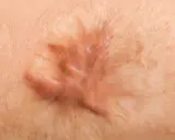 Primo piano di pelle con un segno che ricorda una foglia, risultato di tessuto cicatriziale interno.