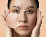Primo piano di una donna con cerchi tratteggiati che evidenziano rughe e pori dilatati, suggerendo un trattamento di peeling.