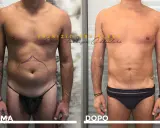 Prima e dopo liposuzione pube uomo. Addome più definito e tonico, con contorni migliorati.