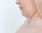 Primo piano del profilo di una donna con doppio mento, un'area che molte persone desiderano migliorare per capire come dimagrire sotto il mento.