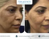 Risultati visibili del trattamento laser CO2 viso: prima e dopo, con pelle più liscia e uniforme.