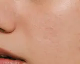 Pelle arrossata e screpolata, con piccole imperfezioni, tipica di un'ustione o un peeling chimico.