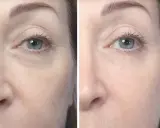 Prima e dopo biorivitalizzazione occhiaie: pelle più liscia e luminosa sotto gli occhi.