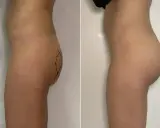 Prima e dopo gluteoplastica mini invasiva: un aumento del volume e della proiezione dei glutei, con un risultato naturale.
