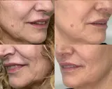 Punture di vitamine viso prima e dopo: la pelle appare più liscia e luminosa, con una riduzione delle rughe e un aspetto più giovane.