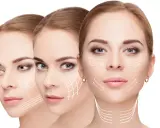 Tre volti femminili con frecce bianche che indicano le linee di tensione del prx viso, suggerendo trattamenti estetici.