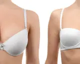 Primo piano di un seno rifatto taglia 4 a goccia, con un reggiseno bianco.