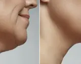 Prima e dopo criolipolisi doppio mento: recensioni positive per un viso più definito e giovane.