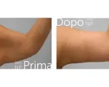 Prima e dopo liposuzione braccia: un braccio più tonico e definito.
