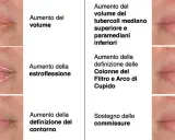 Filler per migliorare volume, estroflessione, definizione contorno, tubercoli, colonne del filtro, arco di Cupido e sostegno delle commissure della bocca.