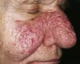 Primo piano del naso e guancia di un uomo con rinofima. La pelle è arrossata, ispessita e presenta noduli. Potrebbe essere utile una crema per rinofima.