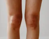 Ginocchia con pelle abbronzata e leggermente secca, evidenziando le pieghe naturali.