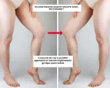 Gambe prima e dopo sclerosanti: la terapia riduce visibilmente le teleangectasie, mostrando un netto miglioramento.