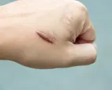 Mano con cicatrice cheloide evidente, un esempio di cheloide prima e dopo il trattamento.
