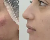 Prima e dopo: pelle con acne e rossori, poi migliorata. Nessun effetto collaterale visibile di Dermamelan.