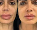 Volto prima e dopo ialuronidasi: labbra più definite e pelle più liscia.