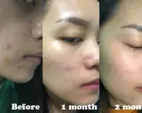 Acne migliorata con acido salicilico: prima, dopo 1 mese e dopo 2 mesi.