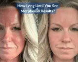 Prima e dopo Morpheus8: il volto arrossato e irritato solleva dubbi sui risultati.