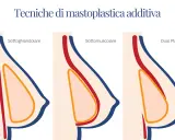Illustrazione delle tecniche di mastoplastica additiva: sottoghiandolare, sottomuscolare e Dual Plane. Le opinioni sulla tecnica Dual Plane variano.
