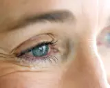 Occhio con evidenti zampe di gallina, un segno del tempo che il botox può attenuare per un aspetto più giovane.
