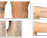 Prima e dopo la rimozione tatuaggi: braccio con tatuaggio tribale e braccio senza, collo con tatuaggio floreale e collo senza, braccio con scritta "never lose faith" e braccio senza.