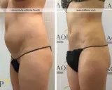 Addome e fianchi prima e dopo liposuzione. La silhouette è visibilmente più snella e definita.
