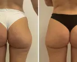 Lipofilling glutei prima e dopo: confronto visivo dei risultati. I glutei appaiono più voluminosi e armoniosi dopo il trattamento.