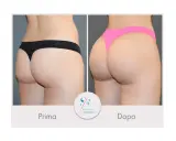 Risultati vaser lipo prima e dopo: glutei più voluminosi e scolpiti.