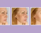 Prima e dopo: il trattamento con fili tensori di collagene migliora la pelle del viso, riducendo rughe e cedimenti.