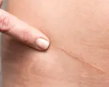 Dito indica una cicatrice da taglio, un segno che si può eliminare per una pelle più liscia.