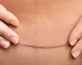 Una cicatrice addominoplastica dopo un anno, sottile e quasi invisibile, testimonia un percorso di trasformazione.