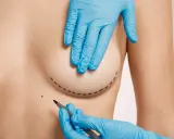 Mani guantate disegnano il contorno per una mastoplastica additiva, segnando il percorso per un futuro miglioramento.