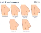 Illustrazione dei gradi di ptosi mammaria: seno normale, lieve, moderata, severa, pseudo ptosi e maldistribuzione. Il seno rifatto può diminuire nel tempo.