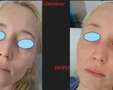 Prima e dopo un trattamento di glutatione per un miglioramento visibile del risultato peeling chimico.