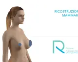 Modello 3D di un torace femminile, con aree evidenziate per illustrare la mastectomia e la ricostruzione mammaria.