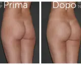 Prima e dopo gluteoplastica senza protesi: un risultato naturale e armonioso.
