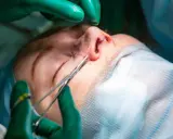 Chirurgo con guanti verdi lavora sul naso, suturando una cicatrice rinoplastica aperta. Strumenti chirurgici e filo blu visibili.