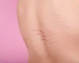 Pelle con smagliature viola, segni di crescita o cambiamenti corporei, su sfondo rosa.