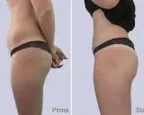 Confronto prima e dopo: la liposuzione come funziona per rimodellare il corpo, riducendo accumuli adiposi e migliorando la silhouette.