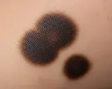 Macchie scure sulla pelle, forse residui di un peeling chimico, con texture visibile.