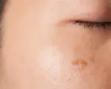 Primo piano del viso con macchie scure sulla pelle, alcune più evidenti vicino all'occhio.