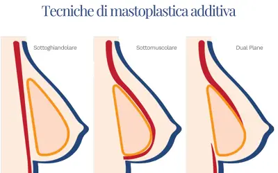Illustrazione delle tecniche di mastoplastica additiva: sottoghiandolare, sottomuscolare e Dual Plane. Le opinioni sulla tecnica Dual Plane variano.