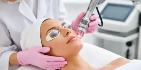 Donna riceve un trattamento laser co2 per il viso, protetta da occhiali speciali.