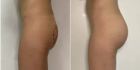 Prima e dopo gluteoplastica mini invasiva: un aumento del volume e della proiezione dei glutei, con un risultato naturale.