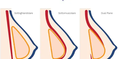 Illustrazione delle tecniche di mastoplastica additiva: sottoghiandolare, sottomuscolare e Dual Plane. Le opinioni sulla tecnica Dual Plane variano.