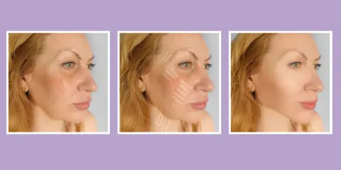 Prima e dopo: il trattamento con fili tensori di collagene migliora la pelle del viso, riducendo rughe e cedimenti.