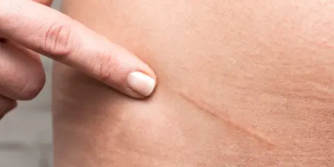 Dito indica una cicatrice da taglio, un segno che si può eliminare per una pelle più liscia.
